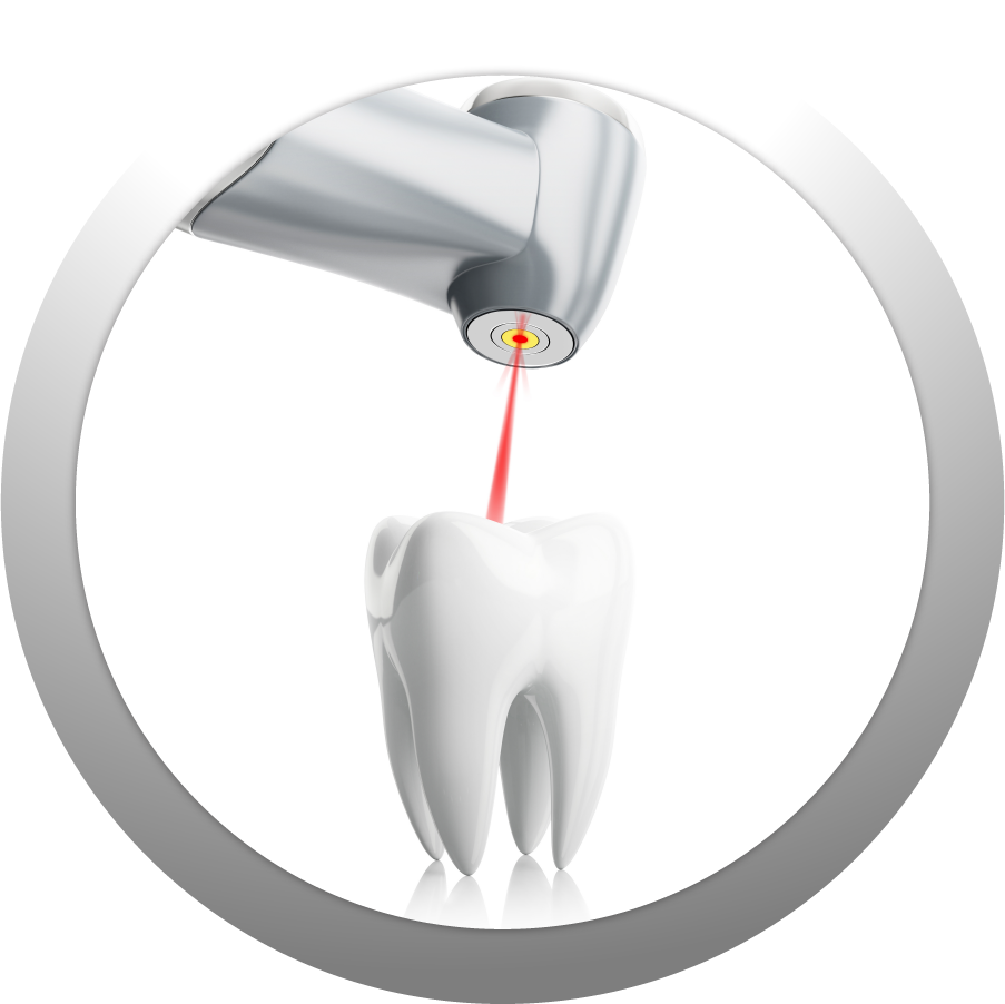 illustration of tooth undergoing laser dentistry treatment