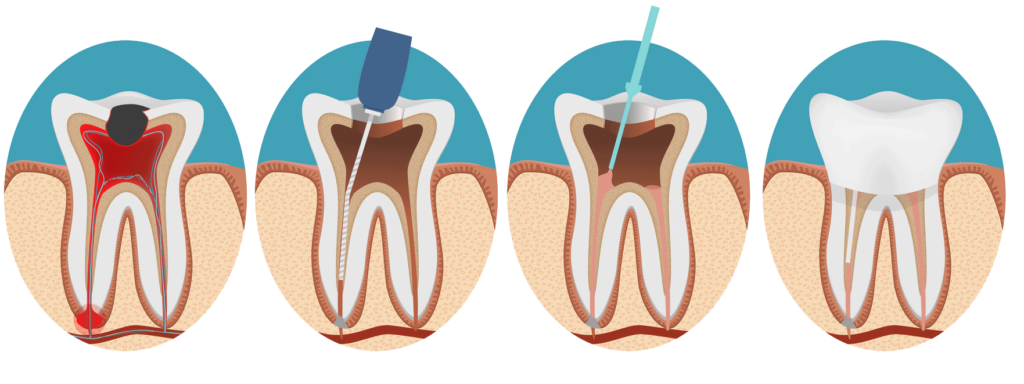 cross section illustration of tooth undergoing different stages of root canal procedure