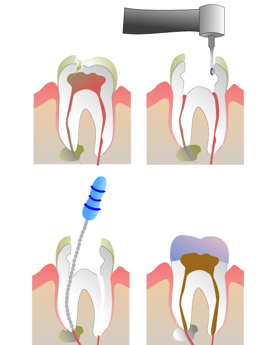 cross section illustration of tooth undergoing root canal procedure