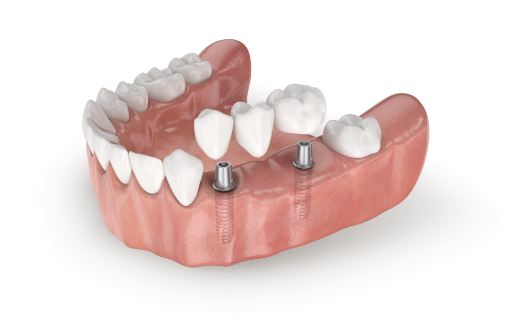 model of teeth with dental implants removed from metal bases