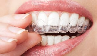 up close of patient placing clear invisalign aligner on upper teeth